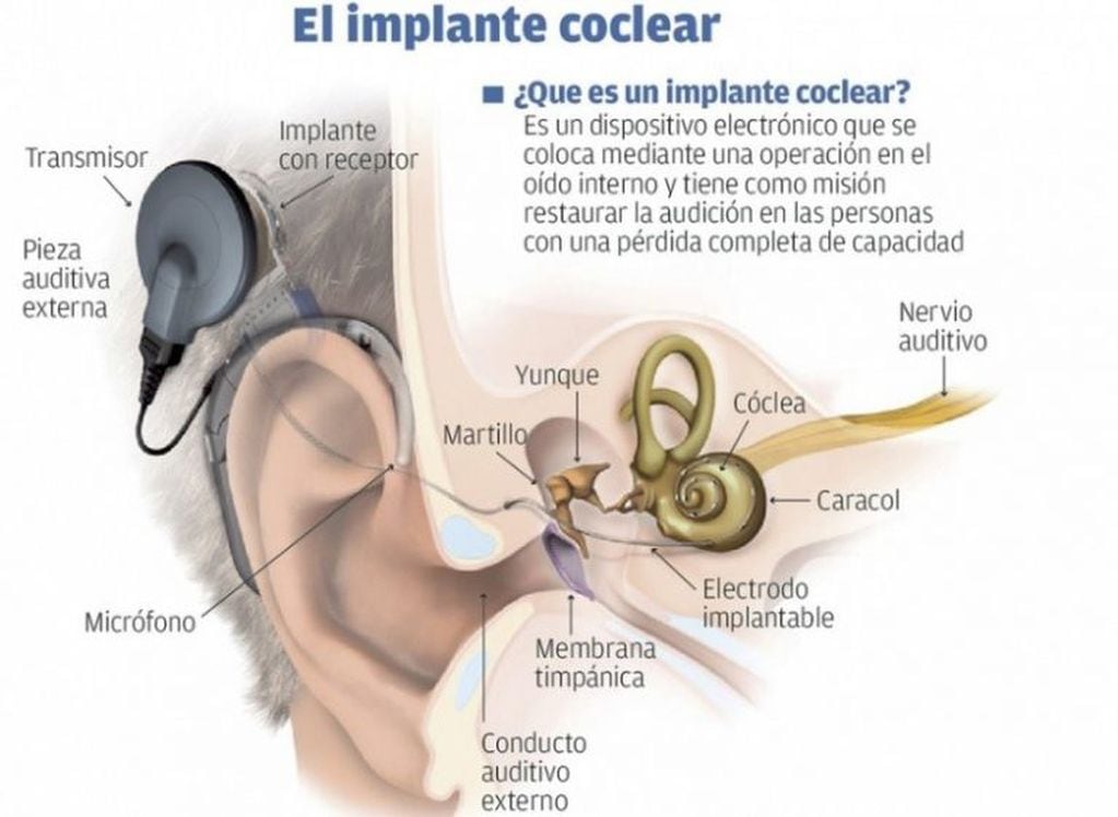Implante coclear.
