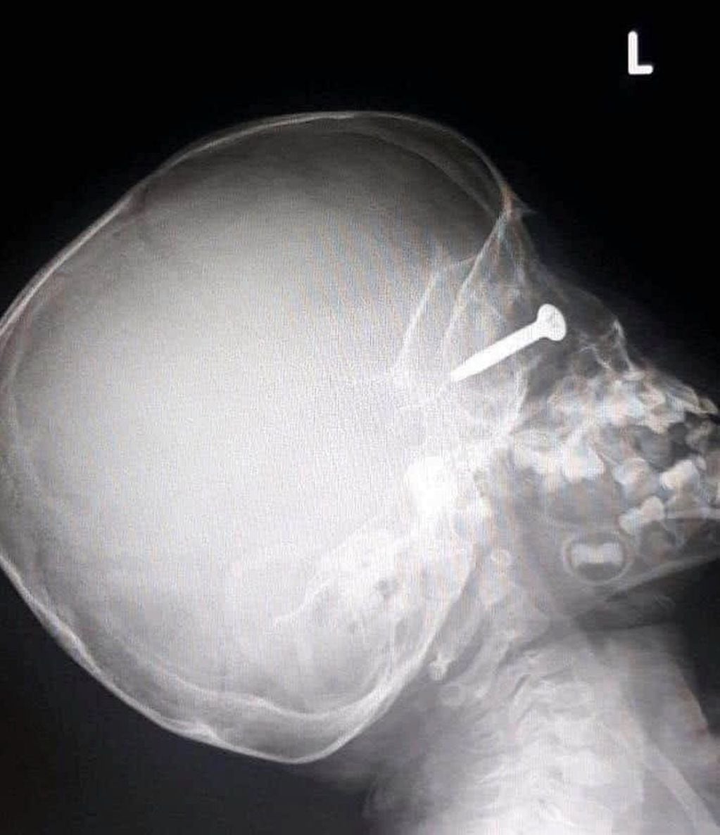 Un nene de 3 años sufrió una terrible lesión ocular cuando su papá cortaba el pasto y un tornillo se engancó en la máquina, voló y se clavó en su ojo.