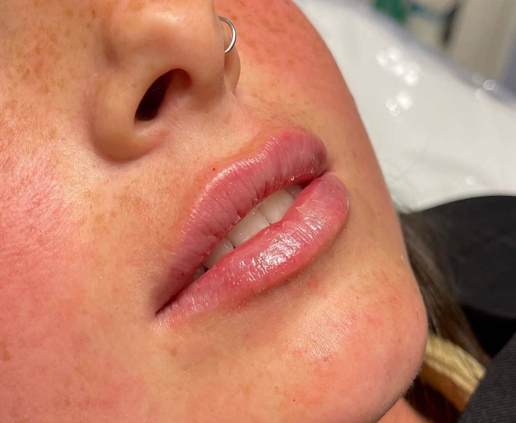 Relleno de ácido hialurónico en labios por la doctora Sofía Mazzaroni.