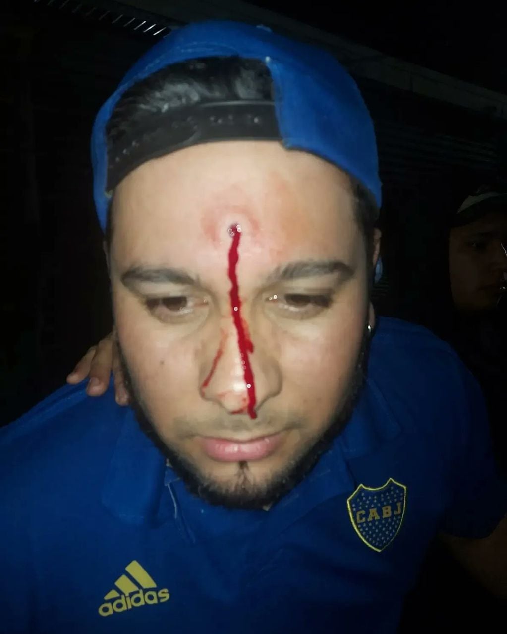Imágenes sensibles: Esteban de Jesús Vallejos recibió un disparo de un aire comprimido. 