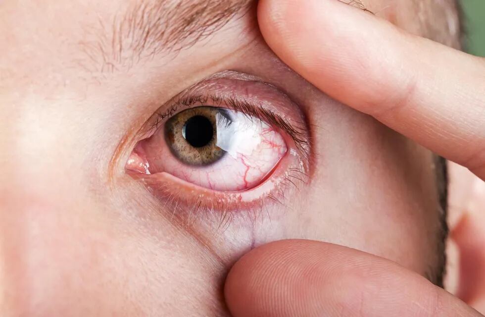La sequedad de los ojos es uno de los síntomas de este síndrome.