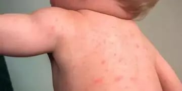Síntomas de dengue en niños