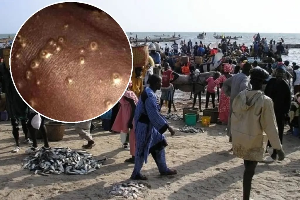 Unos 500 pescadores de Senegal contrajeron una rara enfermedad al volver del mar