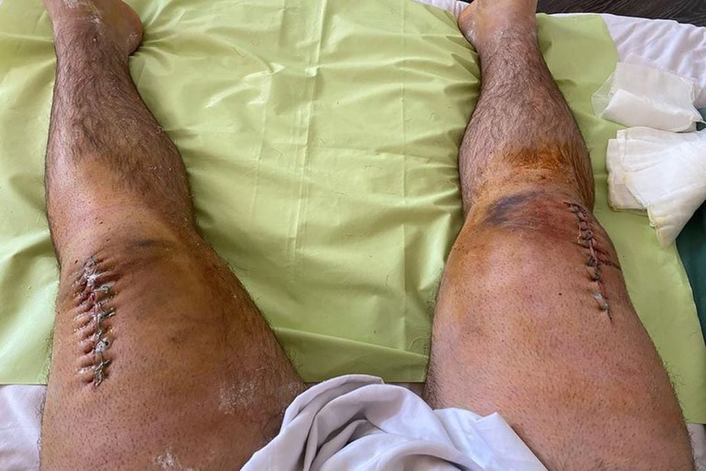 Alexander Sedykh ya fue operado y publicó las imágenes en las redes sociales de cómo quedaron sus piernas. / Gentileza.