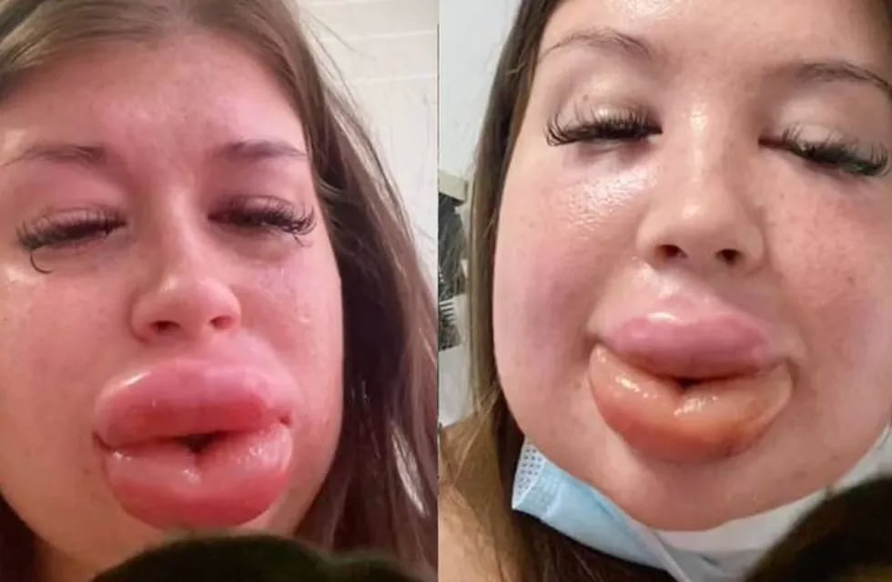 Una joven se inyectó ácido hialurónico en los labios “para ser hermosa” y terminó internada. / Foto: gentileza