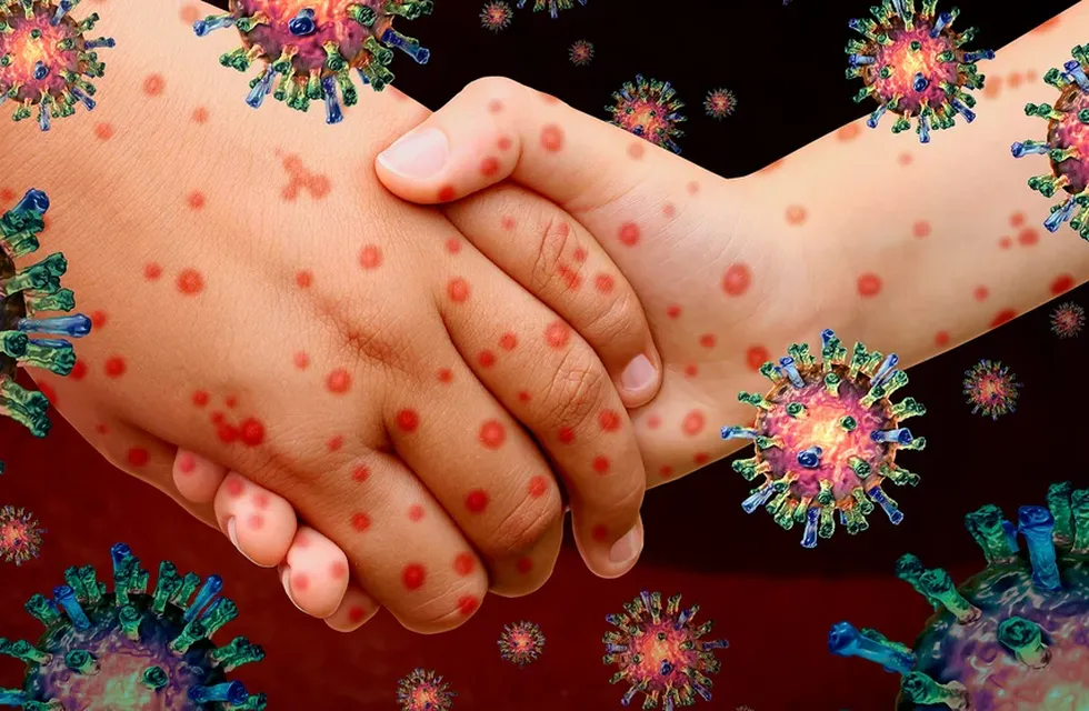 Se baraja que pueda tratarse de una consecuencia de las fiebres del chikungunya o el dengue. Foto: Web