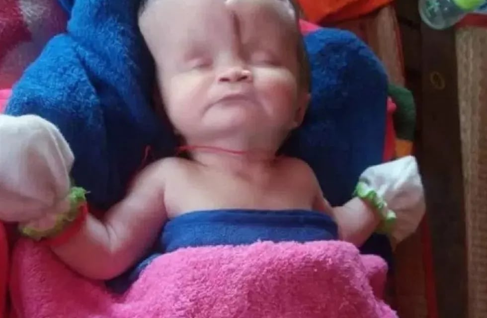 El angustiante caso de la beba de dos meses que nació con la mitad de su cráneo
