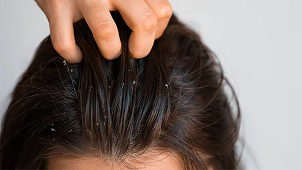La deficiencia de vitamina D se ha relacionado con problemas como la caspa, la picazón y la sequedad del cuero cabelludo.