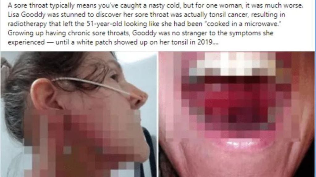 Una mujer pensó que le dolía la garganta por un resfriado pero resultó ser cáncer de amígdalas.