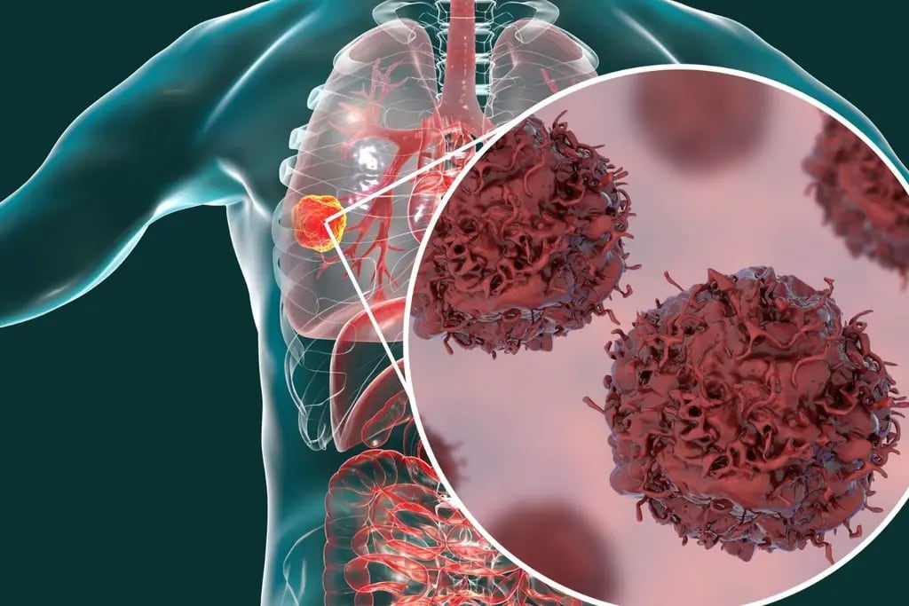 Se presentó un innovador tratamiento para el cáncer de pulmón en el país