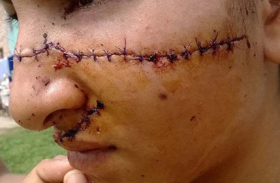 Desfiguraron a una chica de 15 años por “linda y cheta”