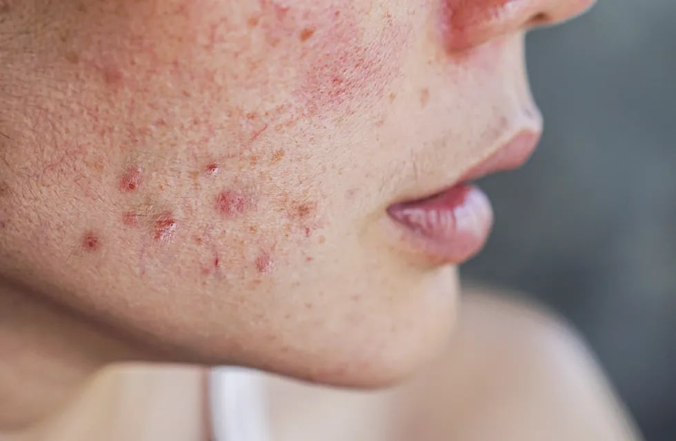 Este es el mejor método natural para eliminar el acné