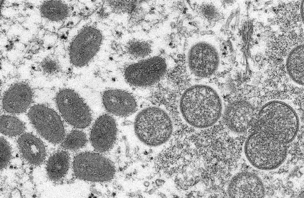 Esta imagen de microscopio electrónico de 2003 proporcionada por los Centros para el Control y la Prevención de Enfermedades muestra viriones maduros de viruela del mono de forma ovalada, a la izquierda, y viriones inmaduros esféricos, a la derecha, obtenidos de una muestra de piel humana (AP)