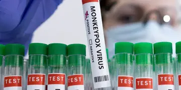 El Ministerio de Salud confirmó el quinto caso de viruela símica en el país