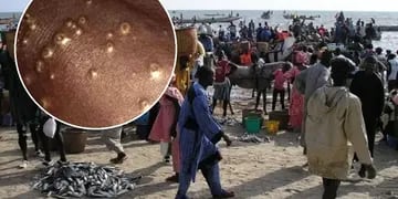 Unos 500 pescadores de Senegal contrajeron una rara enfermedad al volver del mar