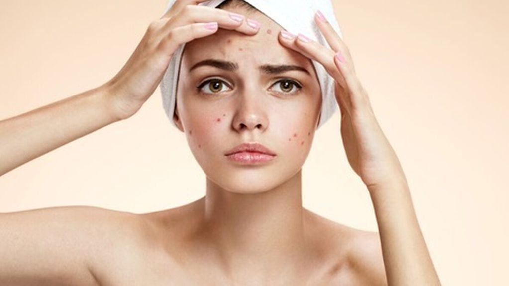 Las pieles con acné requieren de un cuidado previo, durante y luego de la exposición solar.