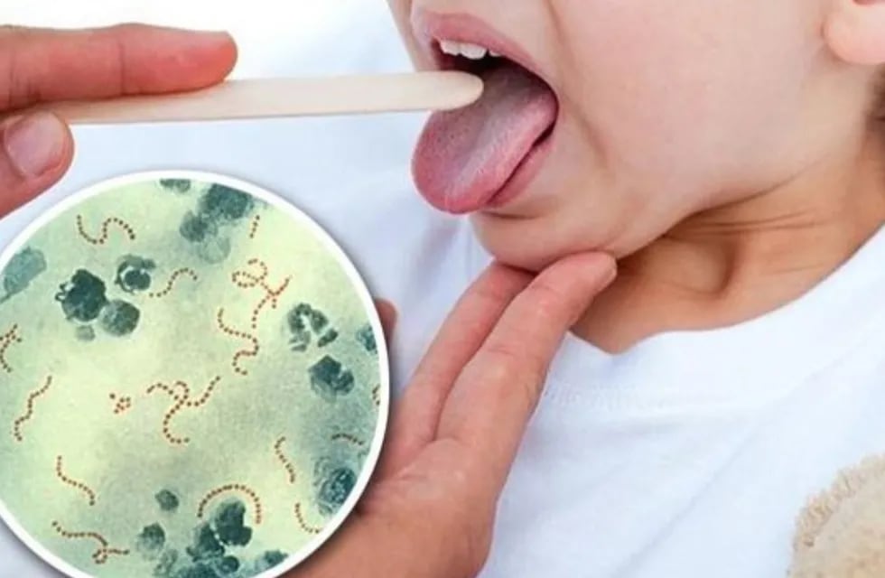 Cuáles son los síntomas del Streptococcus pyogenes
