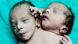 bebé con dos cabezas en la India