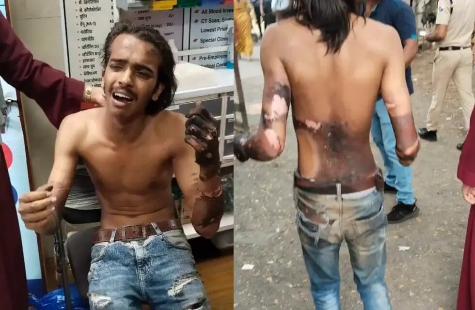 Al final del video se puede ver al joven en una sala de emergencias con importantes quemaduras en la espalda y en uno de sus brazos - Captura de video