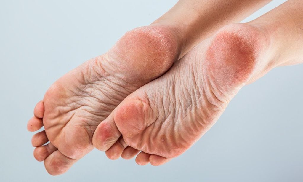 La falta del cuidado de los pies, como no hidratarlos de forma regular o no eliminar la piel muerta, puede contribuir al desarrollo de talones agrietados.
