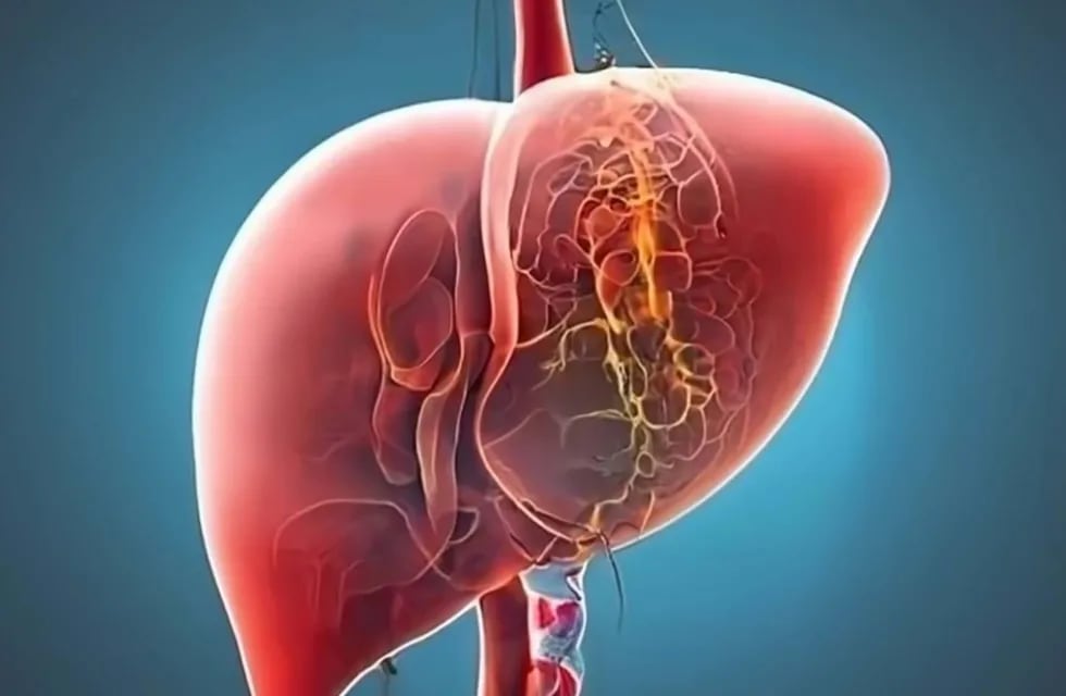 La enfermedad grasa del hígado, actualmente denominada esteatosis hepática es una epidemia oculta.