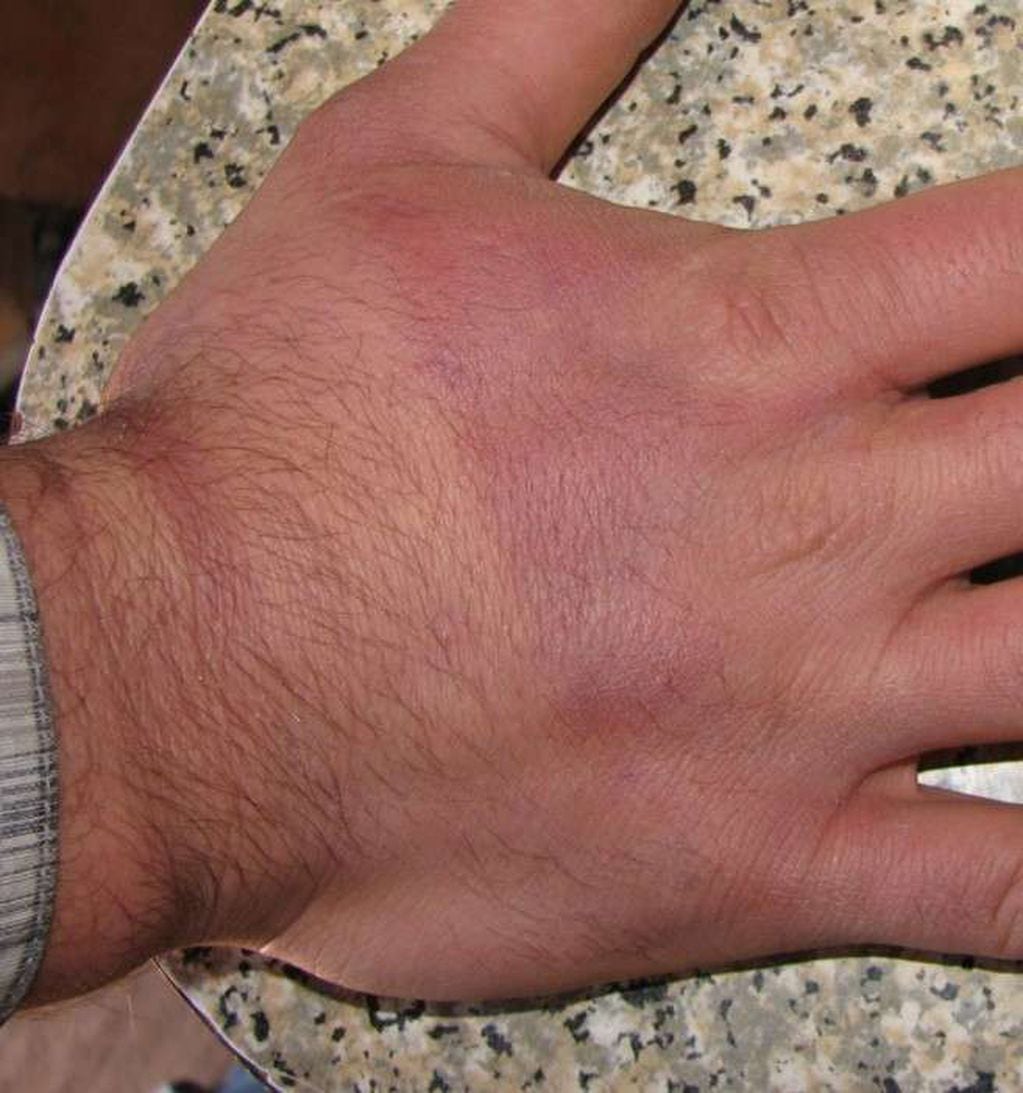 
Quemadura solar del dorso de la mano con la marca de la cinta del bastón de trekking.  | Gentileza
   