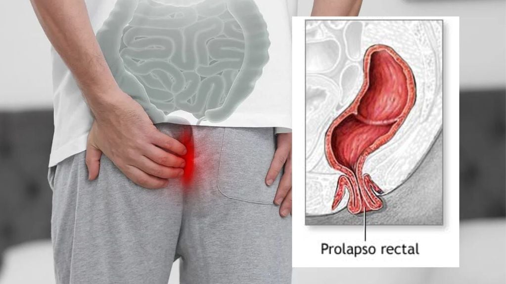 Prolapso rectal, una condición en la cual la fuerza en el área anal se debilita y el ano se descoloca.