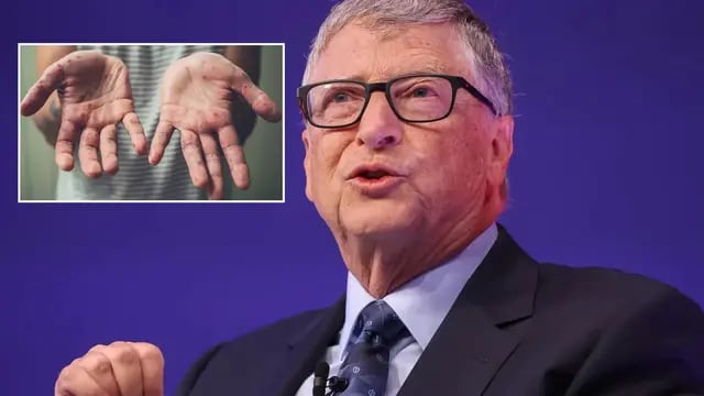 El pronóstico que Bill Gates había realizado sobre la viruela del mono