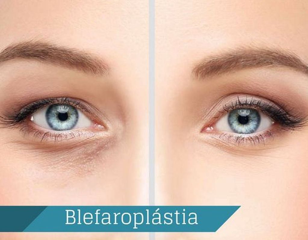 Un antes y después de la cirugía blefaroplástia.