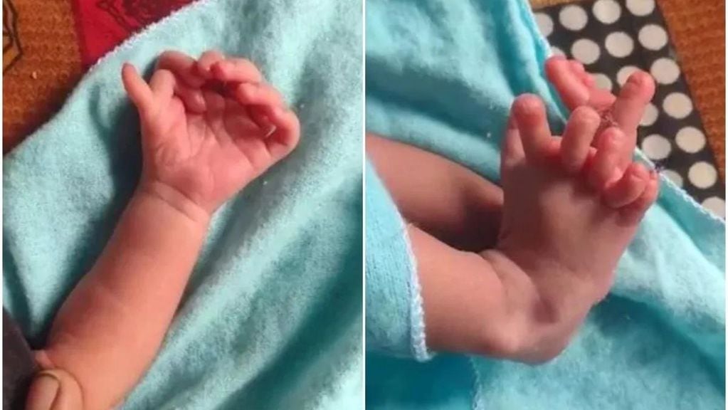 El bebé nació con una peculiaridad genética excepcional: 26 dedos en total, siete en cada mano y seis en cada pie.