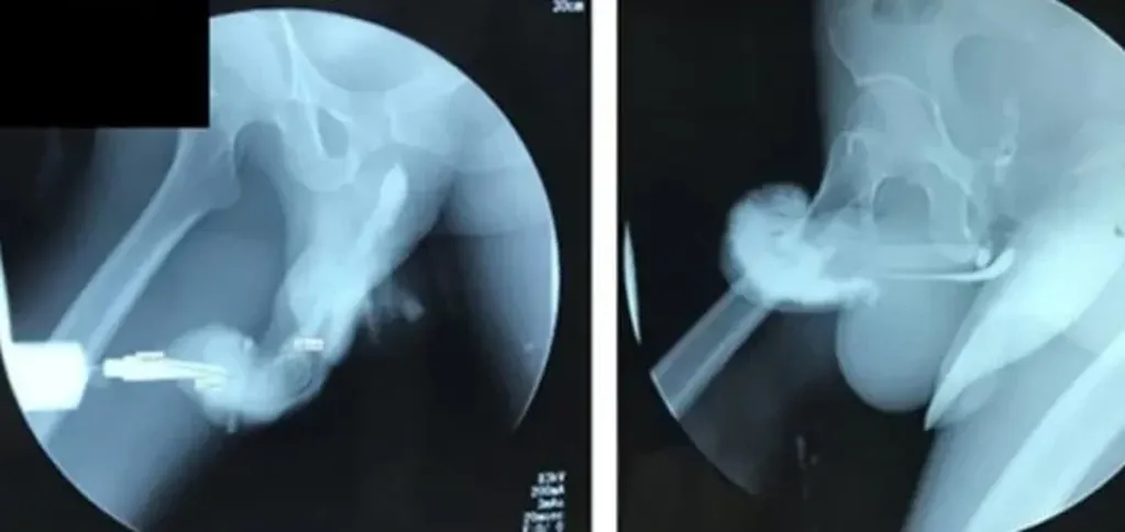 Radiografía de la fractura de pene que sufrió el hombre indonesio.