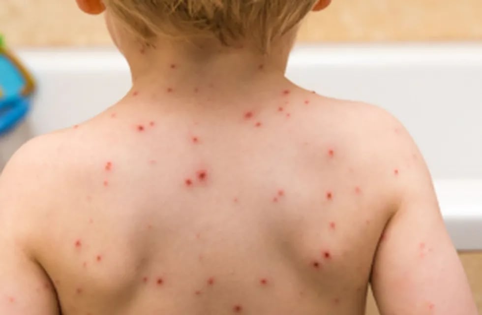 Un posible caso de sarampión detectado en CABA llevó a un alerta epidemiológico: piden controlar la vacunación