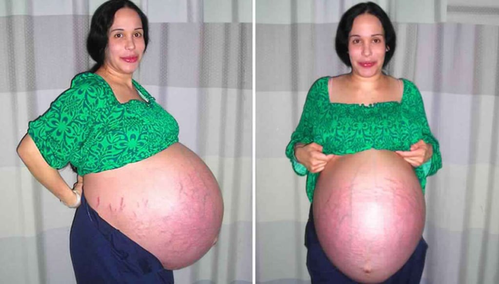 Nadya Suleman dio a luz a octillizos y se la conoce como “la Octomamá” u “Octomom”.