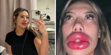 Video: se sometió a una cirujía para tener labios carnosos y quedó internada por una reacción alérgica