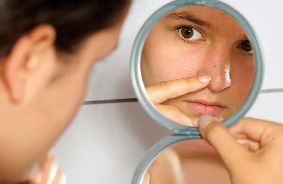 Cómo quitar el acné en 3 días de manera natural (Imagen ilustrativa / Web)