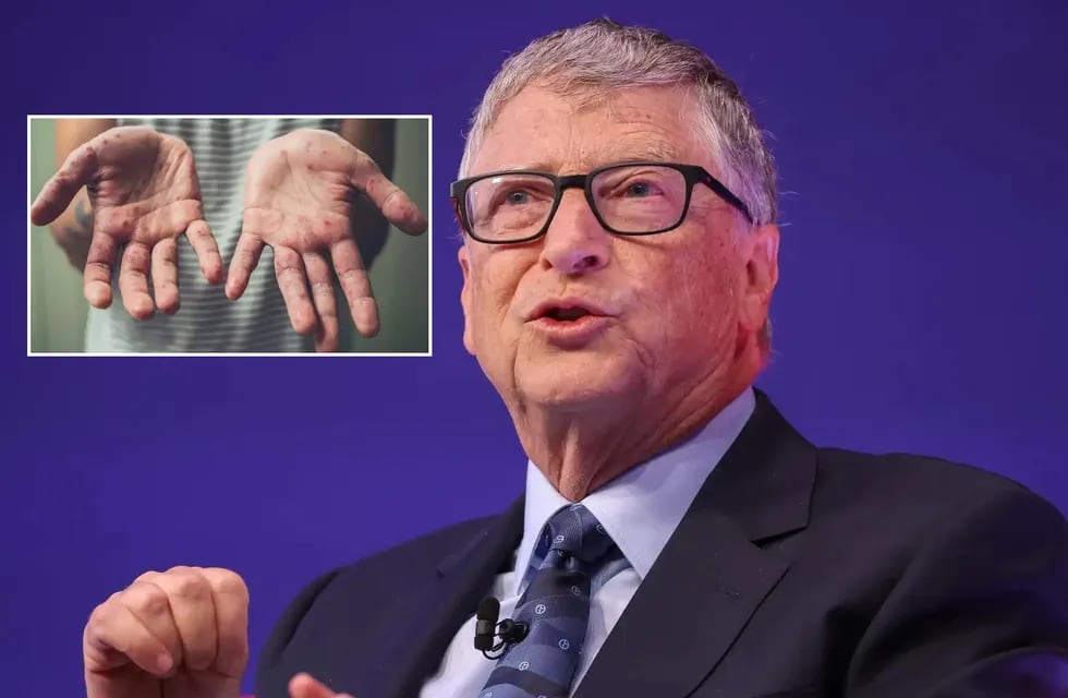 El pronóstico que Bill Gates había realizado sobre la viruela (Imagen web)