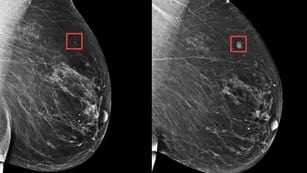 Detección cáncer de mama con IA