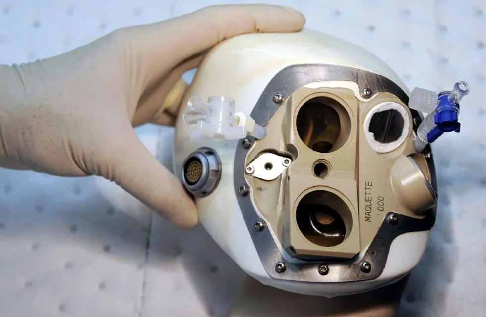 Un corazón artificial autónomo fue implantado en Francia