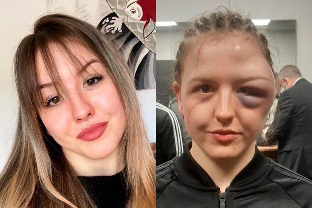 La boxeadora alemana Cheyenne Hanson compartió una foto del antes y después de su rostro tas la pelea. Foto: Twitter.