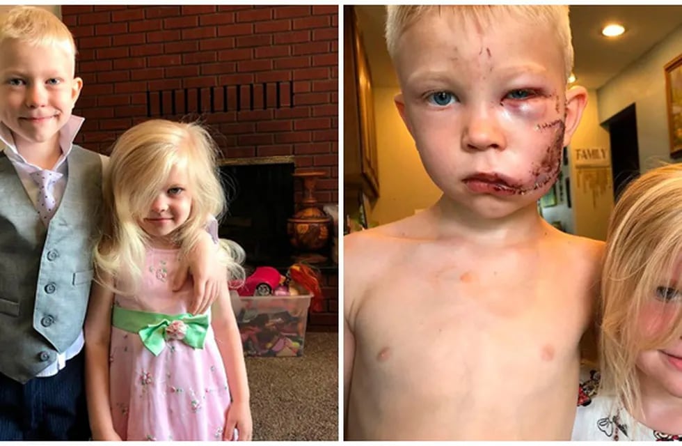 El niño de seis años salvó a su hermana de ser atacada por un perro y recibió casi 100 puntos sutura en el rostro y la cabeza.
