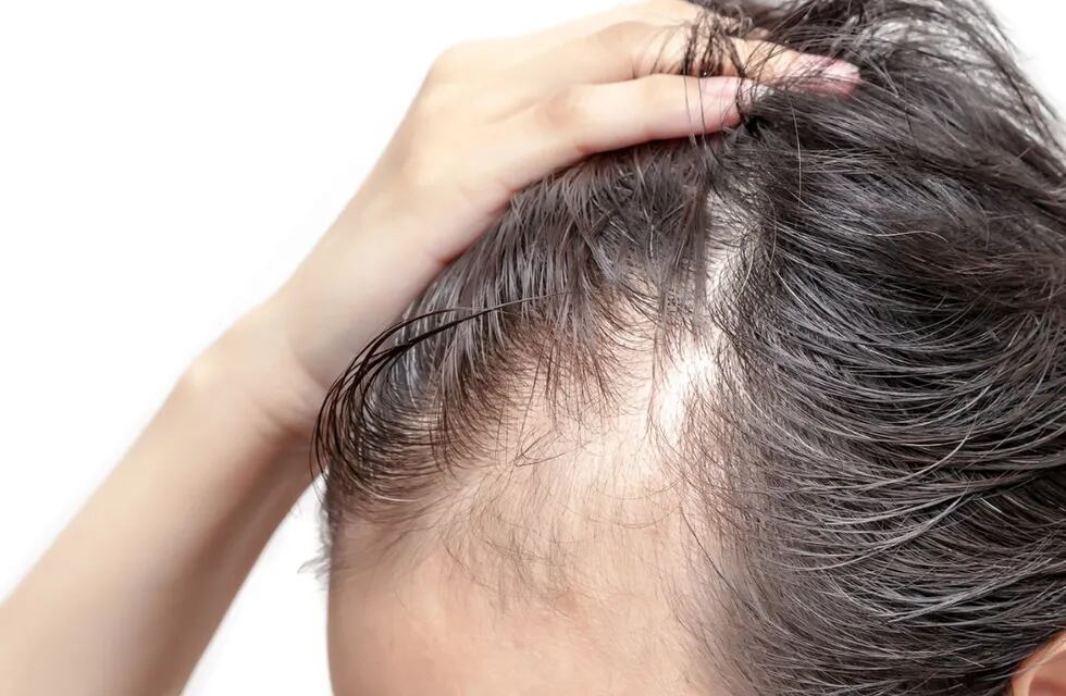 La caída del cabello es un nuevo síntoma detectado luego de padecer la variante Ómicron. Foto: Gentileza