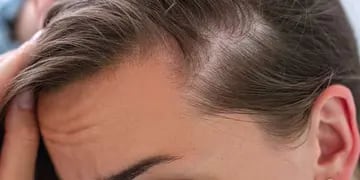Qué es la alopecia androgenética y qué consejos dan los dermatólogos para detectarla a tiempo