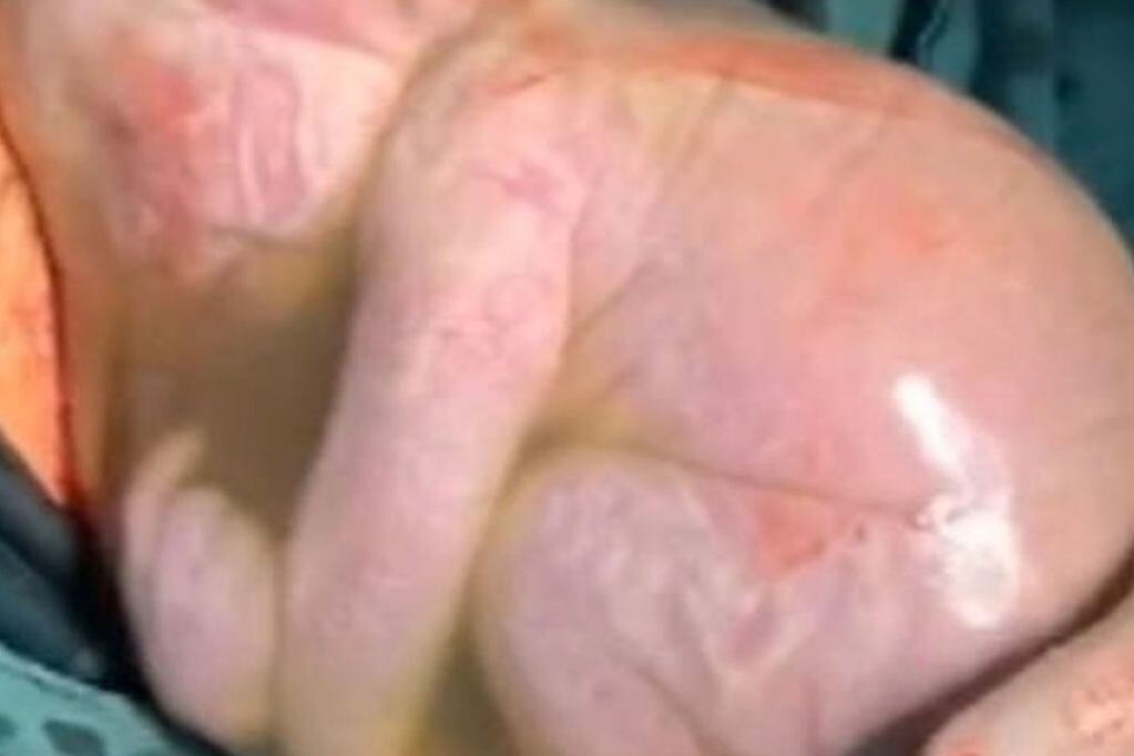 Impresionantes imágenes de un bebé nacido por cesárea con el saco amniótico 