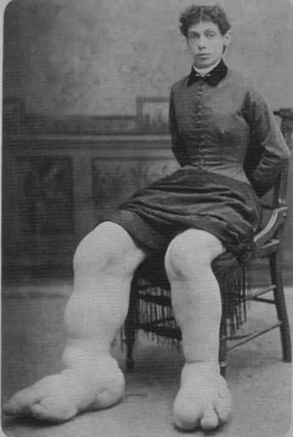 Fanny Mills sufría una enfermedad rara que deformaba sus extremidades inferiores. Murió a los 39 años. Gentileza.