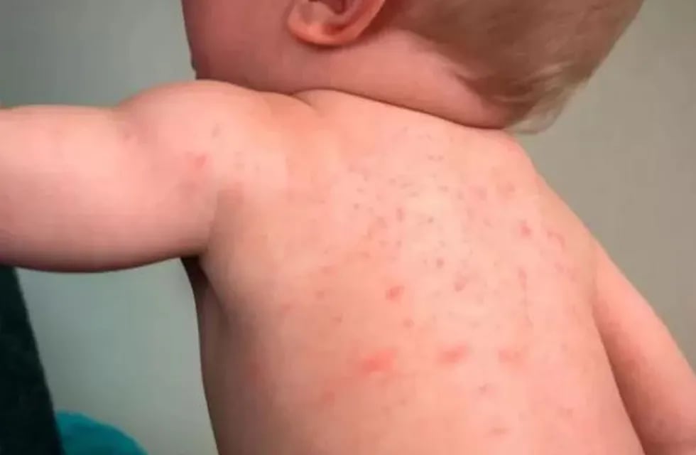 Síntomas de dengue en niños.