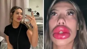Video: se sometió a una cirujía para tener labios carnosos y quedó internada por una reacción alérgica