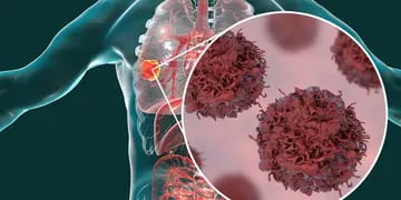 Se presentó un innovador tratamiento para el cáncer de pulmón en el país