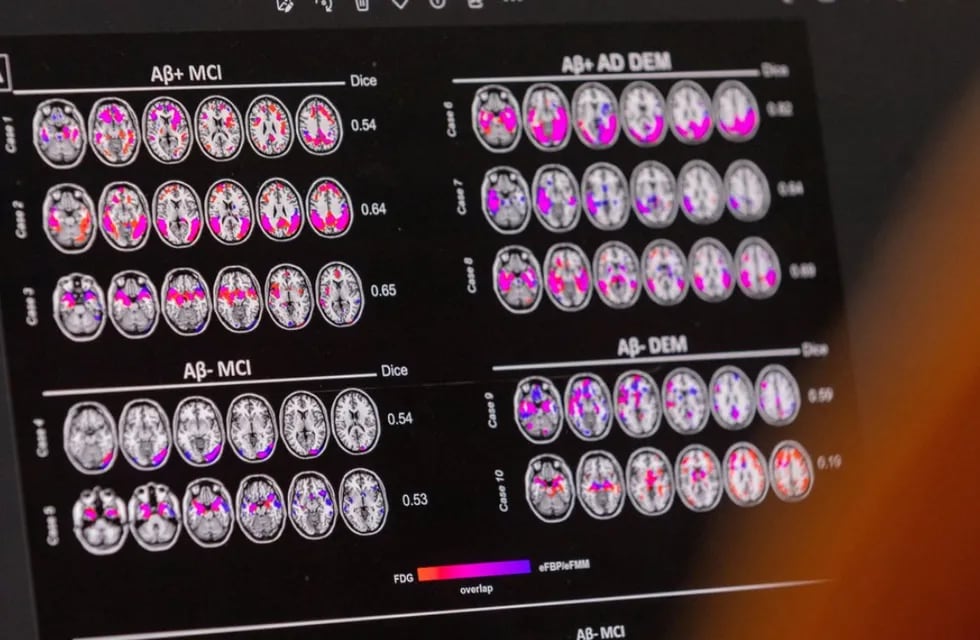 Los escáneres cerebrales pueden detectar niveles anormales de una proteína llamada beta amiloide. Gentileza: Noticias Argentinas.