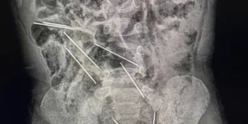 Un niño de 2 años tuvo una cirugía de emergencia tras ingerir 8 agujas para inyectar ganado
