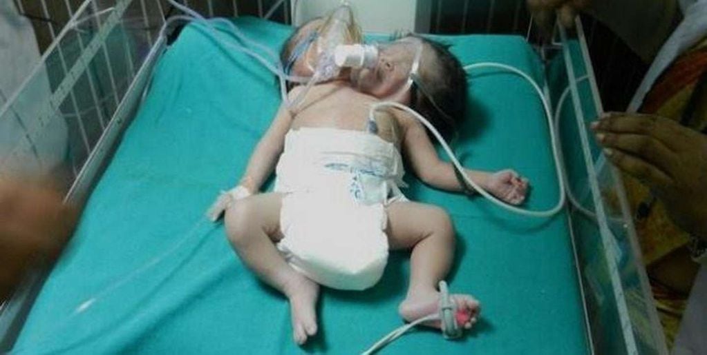 Un bebé nació con dos cabezas, tres manos y dos corazones en la India. / Foto: gentileza